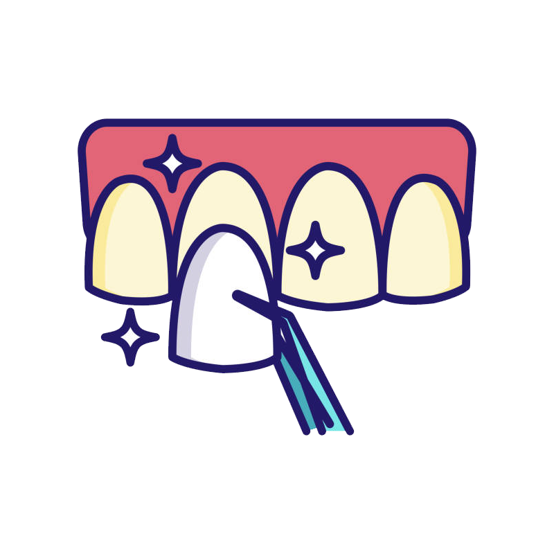 فينير الاسنان 